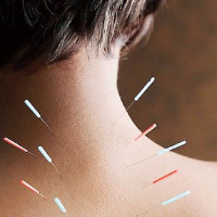 Dry Needling physiotherapy